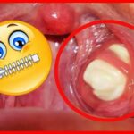 Como Remover as Bolinhas Fedidas da Garganta que Causam Mau Hálito! | Dicas de Saúde 1EB67DBDC43Cw900h506