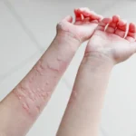 Coçava o corpo todo: o que ele acreditava ser uma alergia comum escondia algo mais sério Imagem da página de origem