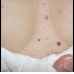 Pontinhos vermelhos no corpo! o que são, quando se preocupar 637