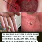 Bolinhas Brancas que Saem da Boca! O Que São e Como Tratar 722
