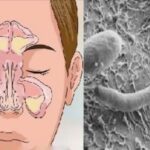 Nariz entupido, rinite ou sinusite? Seu problema está no intestino - saiba como resolver! Imagem da página de origem