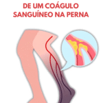 10 principais sinais de um coágulo sanguíneo na perna: como prevenir a trombose venosa profunda Imagem da página de origem