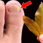 Elimina fungos nas unhas instantaneamente! Não gaste mais na farmácia! Imagem da página de origem