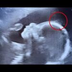 Os médicos ficaram chocados durante o ultrassom: a história dessa bebê vai te surpreender Imagem da página de origem