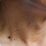 As verrugas plantares e os acrocordons desaparecem em apenas um dia com este remédio natural Imagem da página de origem