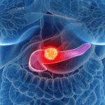 Câncer de pâncreas: sinais e sintomas aos quais é preciso estar atento para a detecção precoce Imagem da página de origem