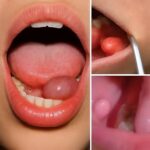 Sinais de que estão aparecendo bolinhas na boca | Receitas Salgadas 937