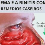 Muco e Catarro: Remédios Caseiros Eficazes Imagem da página de origem