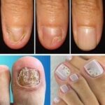 Diga Adeus à Micose de Unha: Soluções Caseiras Eficazes e Completas 034c9088-8905-4ac9-ab5f-a36f0dc91268
