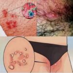 Irritação na Virilha: Sinais, Causas e Como Lidar com o Desconforto a9d4d585-63d3-45bc-9cda-a4f2713be49b