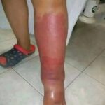 Inflamação: Reconheça os Primeiros Sintomas e Opções de Tratamento Natural d47ad901-a5af-4870-82a8-5ccfa18de333-3