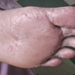 Diabetes Oculto: Sinais nos Pés Que Você Não Pode Ignorar 018db1ea-d81f-4c27-a55c-462ddc0d9bf7