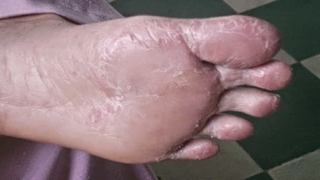 Diabetes Oculto: Sinais nos Pés Que Você Não Pode Ignorar